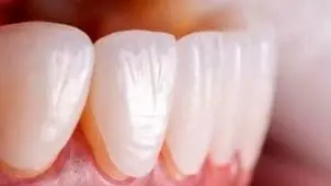 چگونه عمر لمینت دندان هایتان را افزایش بدهید؟