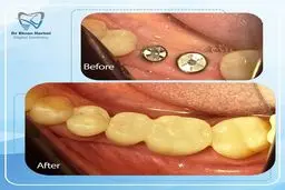 ایمپلنت دندان فوری در مشهد؛ بدون درد و جراحی