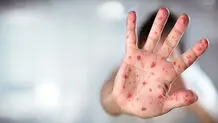 نگرانی از همه‌گیری سرخک