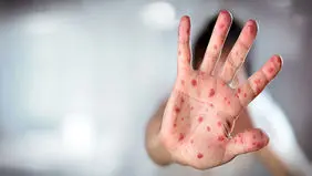 نگرانی از همه‌گیری سرخک