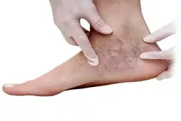 وقتی پاها بیماری را لو می‌دهند؛ این علائم را جدی بگیرید