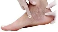 وقتی پاها بیماری را لو می‌دهند؛ این علائم را جدی بگیرید
