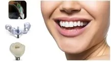 مراقبت بعد از ایمپلنت دندان برای کاهش عوارض و خطرات آن
