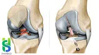 درمان پارگی رباط صلیبی چگونه است؟