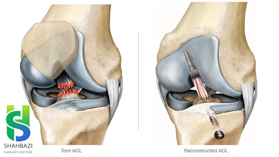درمان پارگی رباط صلیبی چگونه است؟