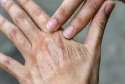 تاثیر آلودگی هوا بر پیری پوست