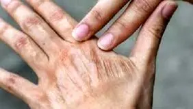 تاثیر آلودگی هوا بر پیری پوست