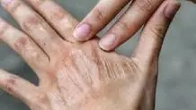 تاثیر آلودگی هوا بر پیری پوست