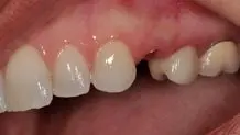 صحنه عجیب شکستن دندان داور توسط والیبالیست ایرانی+ عکس