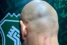 تصویری از جراحت مربی دروازه بانان استقلال بعد از بازی با خیبر