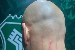 تصویری از جراحت مربی دروازه بانان استقلال بعد از بازی با خیبر