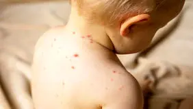شناسایی ۶۷۴ ابتلا به سرخک

