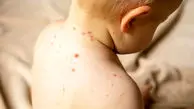 شناسایی ۶۷۴ ابتلا به سرخک

