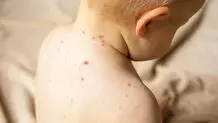 شناسایی ۶۷۴ ابتلا به سرخک

