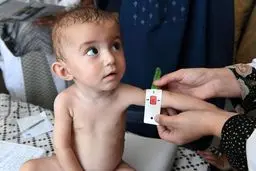 حمایت از ۲۰۰ هزار کودک مبتلا به سوء تغذیه در سال ۱۴۰۴
