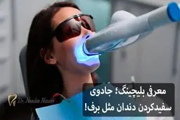 معرفی بلیچینگ؛ جادوی سفیدکردن دندان مثل برف!