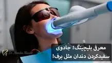 معرفی بلیچینگ؛ جادوی سفیدکردن دندان مثل برف!