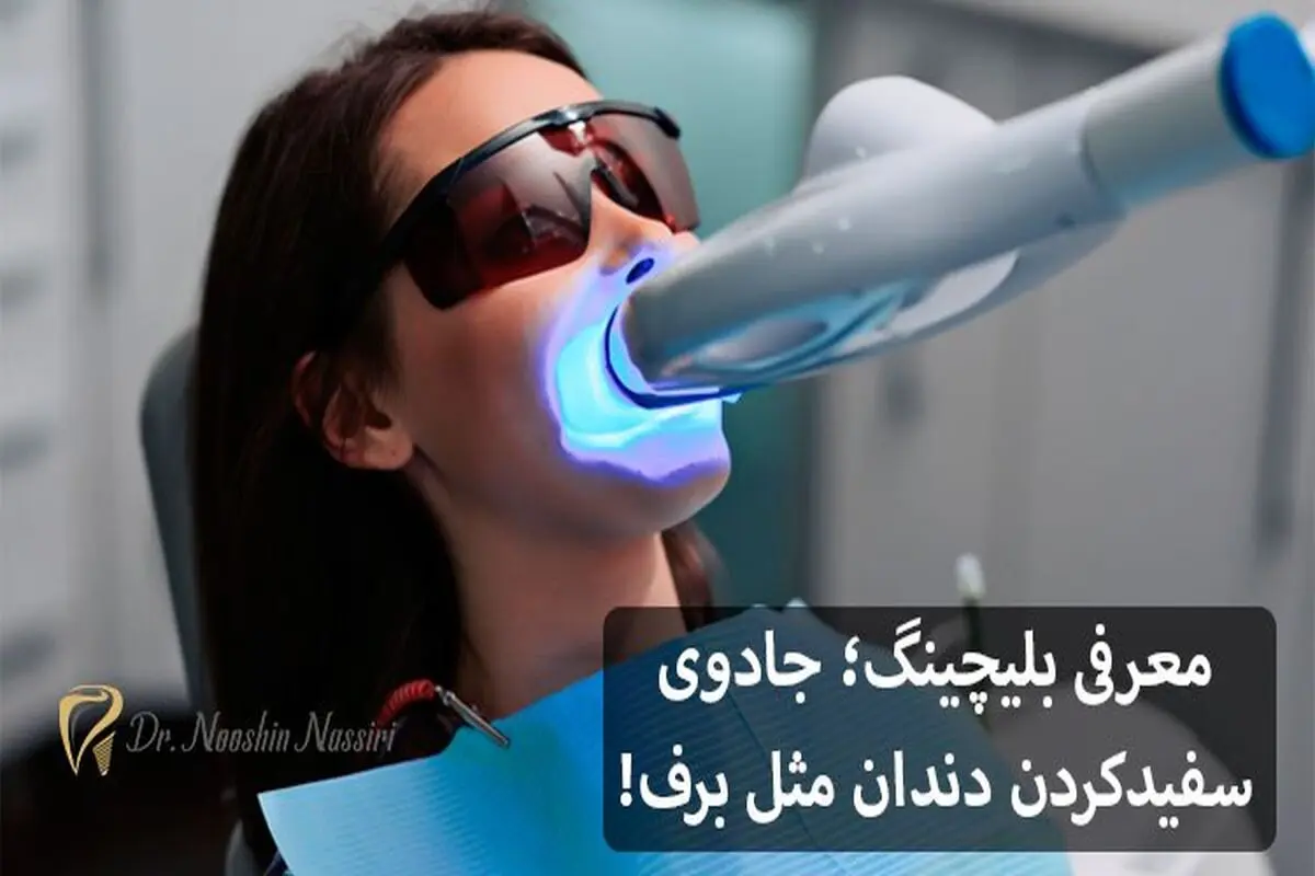 معرفی بلیچینگ؛ جادوی سفیدکردن دندان مثل برف!