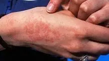 هشدار نسبت به شیوع تب مالت در تربت حیدریه+فیلم