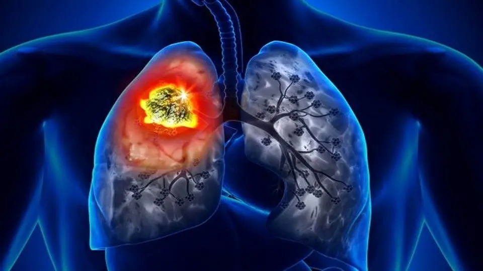 دانشمندان اسپادژن موفق به کشف درمان قطعی سرطان ریه شدند
