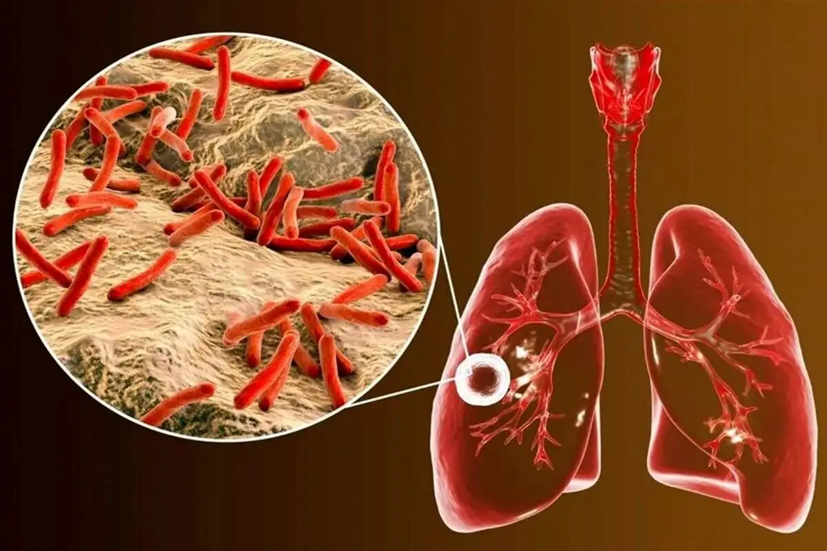 هشدار درباره بیماری جدید؛ آمار اتباع مبتلا چقدر است؟