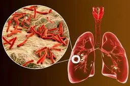 هشدار درباره بیماری جدید؛ آمار اتباع مبتلا چقدر است؟
