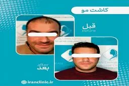 سن مناسب برای کاشت مو چند سال است؟ و به چه عواملی بستگی دارد؟
