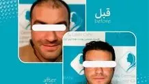 سن مناسب برای کاشت مو چند سال است؟ و به چه عواملی بستگی دارد؟