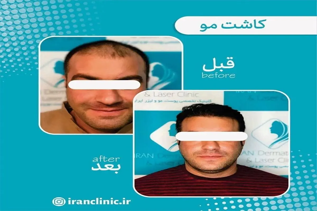 سن مناسب برای کاشت مو چند سال است؟ و به چه عواملی بستگی دارد؟