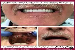 انواع برند های ایمپلنت دندان در ایران کدام است؟
