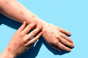 گزارش جدید سازمان جهانی بهداشت درباره آبله میمونی