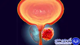 راه های تشخیص زودهنگام سرطان پروستات