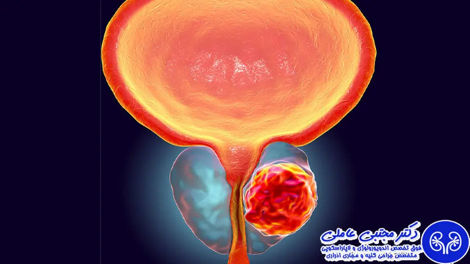راه های تشخیص زودهنگام سرطان پروستات