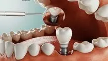 تکنولوژی CAD-CAM در دندانپزشکی دیجیتال چیست؟