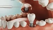هزینه ایمپلنت دندان چقدر است و چه مزایا و معایبی دارد؟