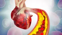 کاهش قابل توجه خطر سکته مغزی با این راهکار آسان