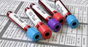 چه کسانی باید آزمایش «ایدز» بدهند

