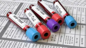 واکسن موثری علیه ایدز در جهان نداریم/ دسترسی رایگان بیماران ایرانی به داروهای HIV